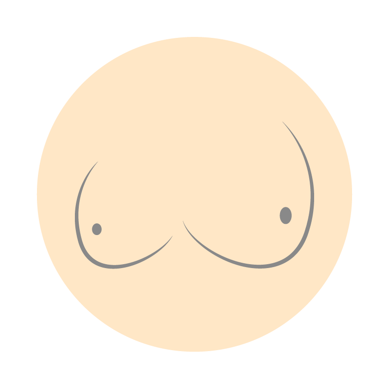 隆乳重修：假體位移
