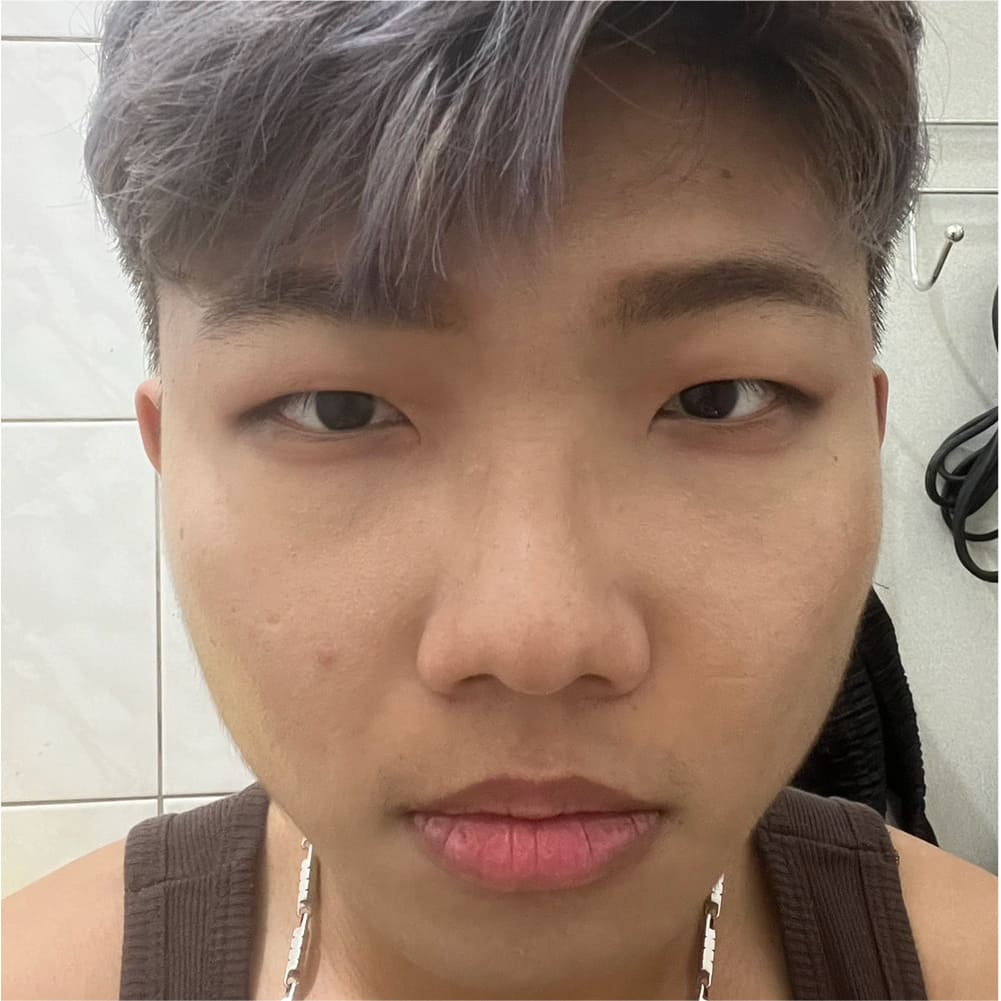 隆鼻割雙眼皮墊下巴前的我2
