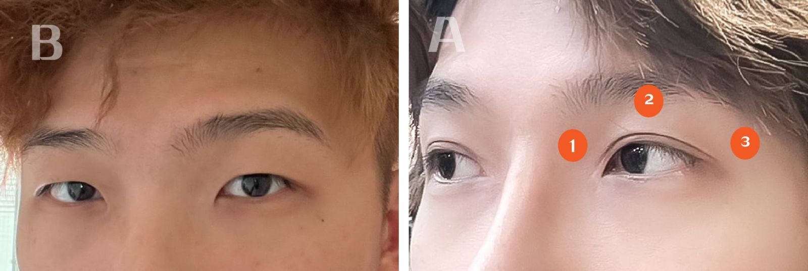 割雙眼皮、開眼頭、提眼肌前後對比