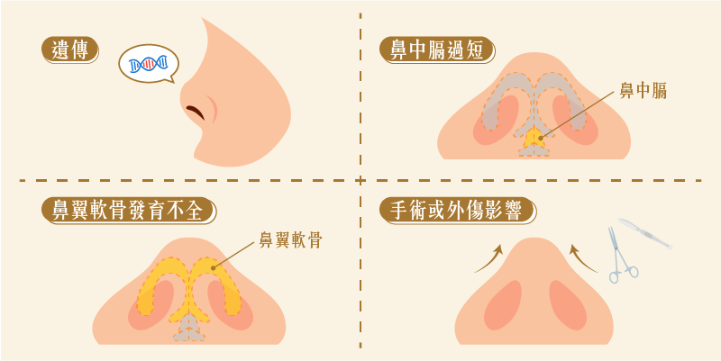 朝天鼻的成因與改善方式：手術矯正與常見問題M2