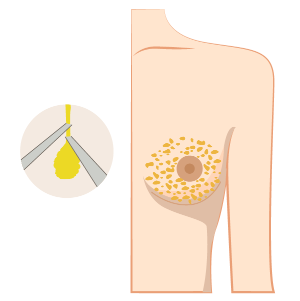 乳腺切除術