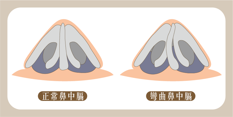 鼻中膈彎曲M