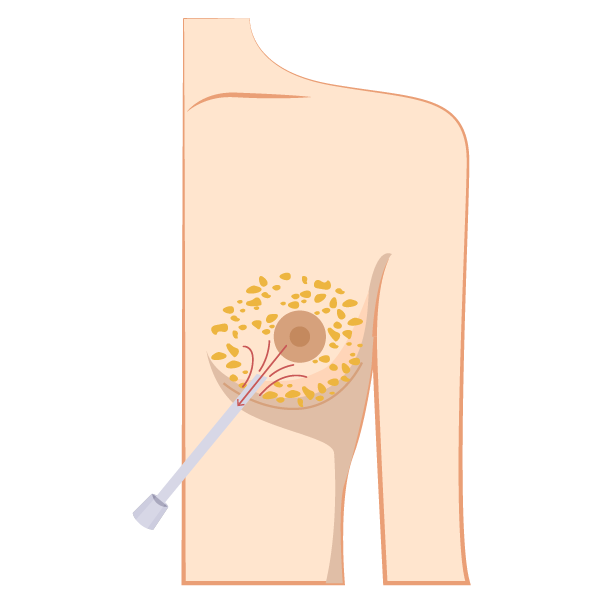 抽脂手術（Liposuction）M