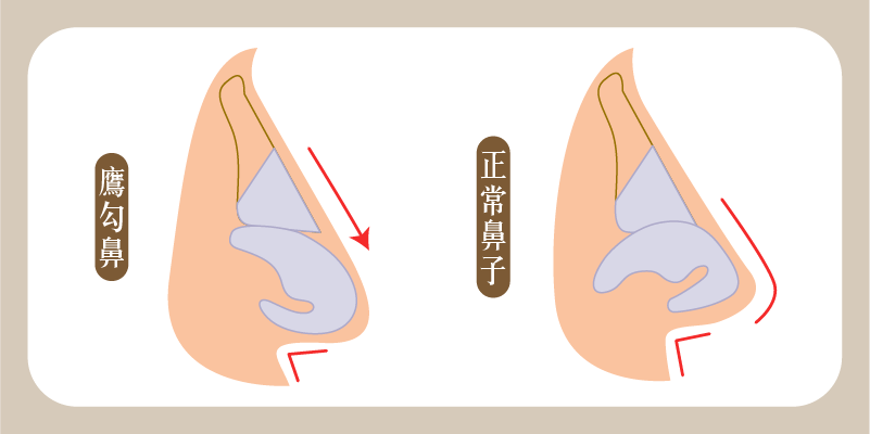 鷹勾鼻與正常鼻比較M