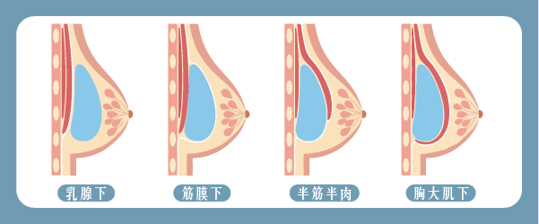 隆乳假體植入層次