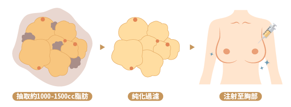 自體豐胸需要多少脂肪？M
