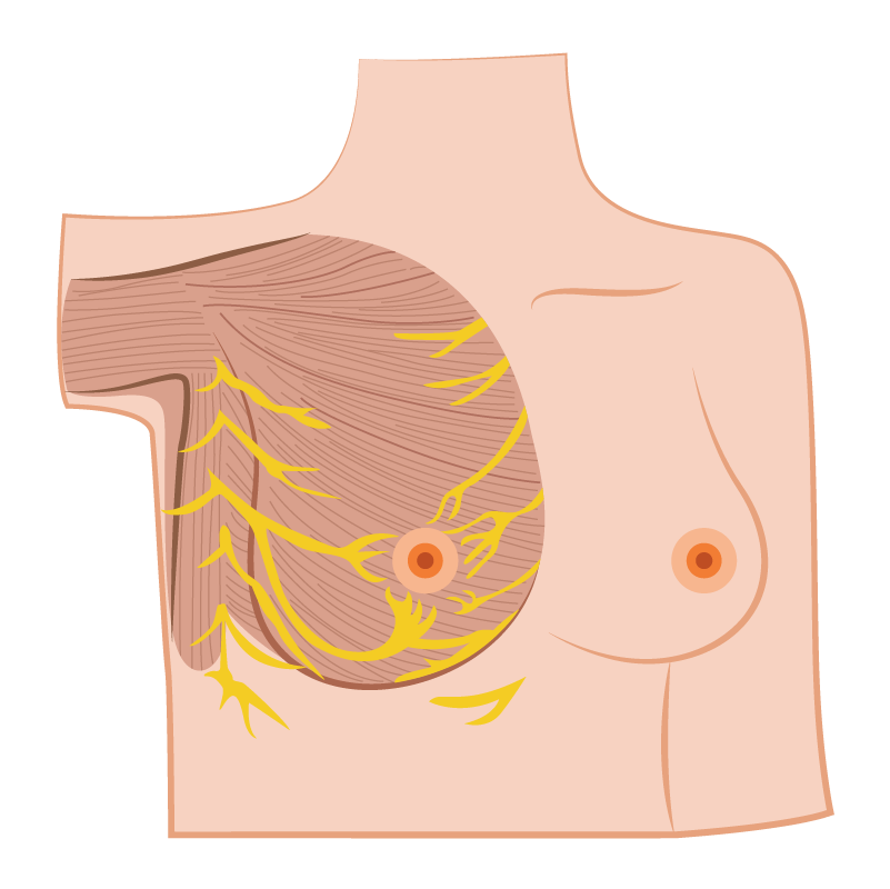 有經驗的醫師熟知乳房組織M