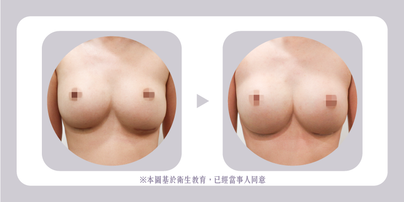 預防性修補與結合其他胸部手術M