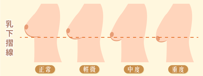 胸部下垂怎麼看？乳下摺線位置是關鍵！未穿內衣時檢查方法M
