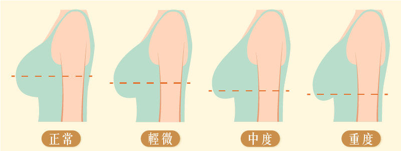 胸部下垂怎麼看？乳下摺線位置是關鍵！穿內衣時檢查方法M
