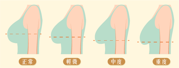 胸部下垂怎麼看？乳下摺線位置是關鍵！穿內衣時檢查方法