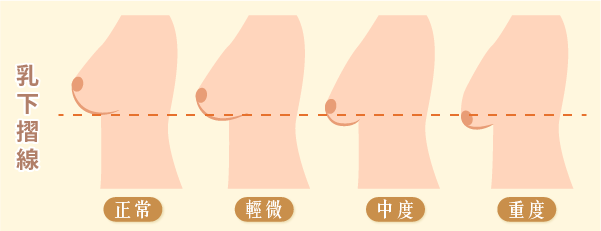 胸部下垂怎麼看？乳下摺線位置是關鍵！未穿內衣時檢查方法
