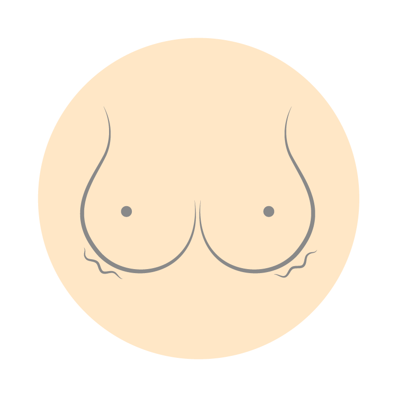 隆乳重修：柔軟度不達預期