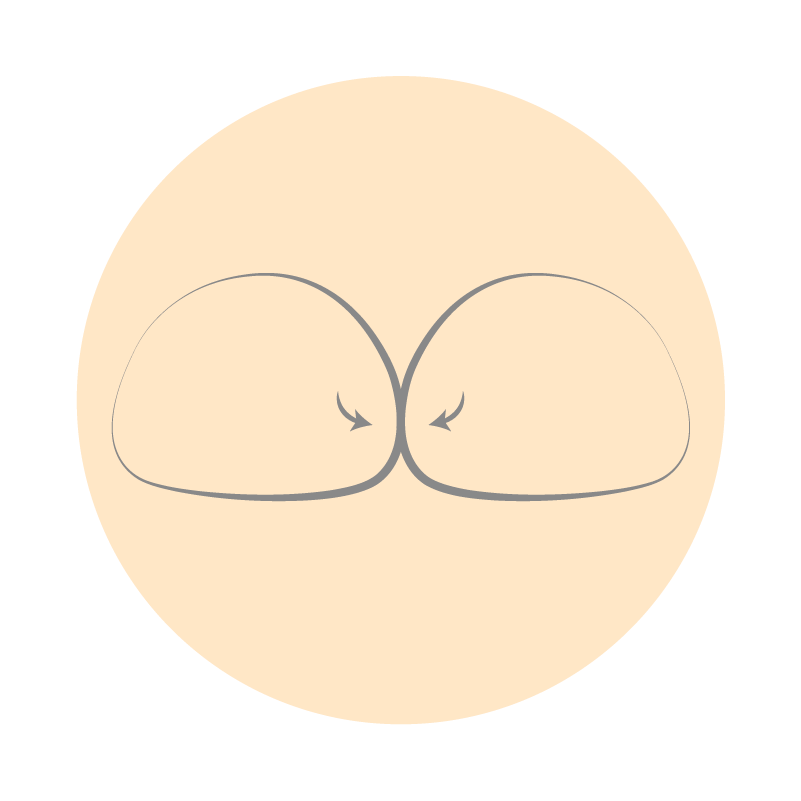 隆乳重修原因：兩側植體空間相通