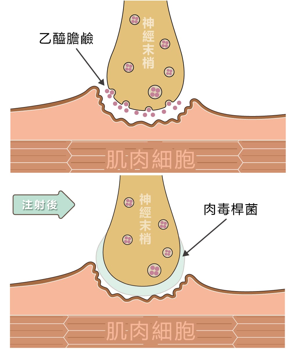 為什麼肉毒桿菌素能除皺撫紋