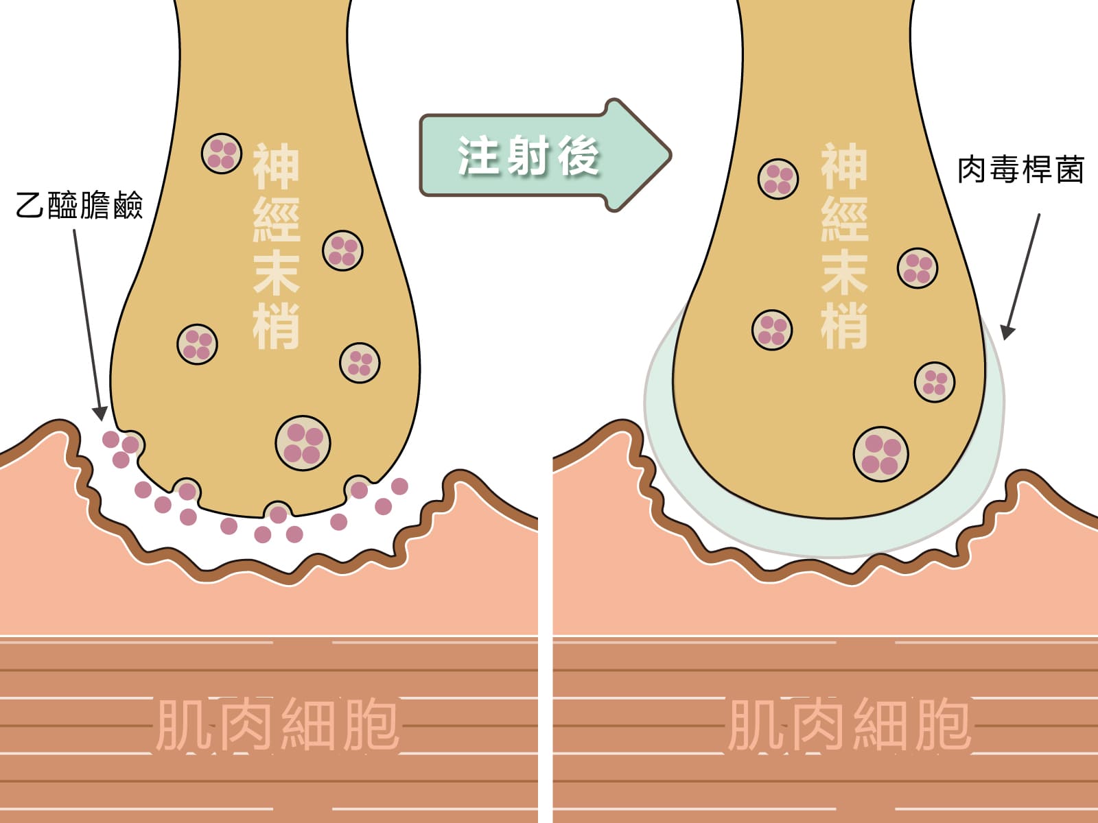 為什麼肉毒桿菌素能除皺撫紋
