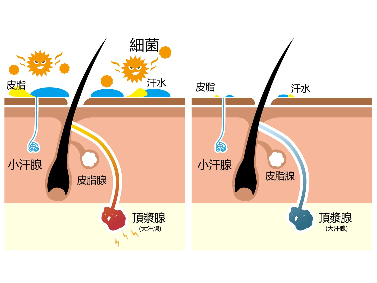 為何注射肉毒桿菌素能止汗