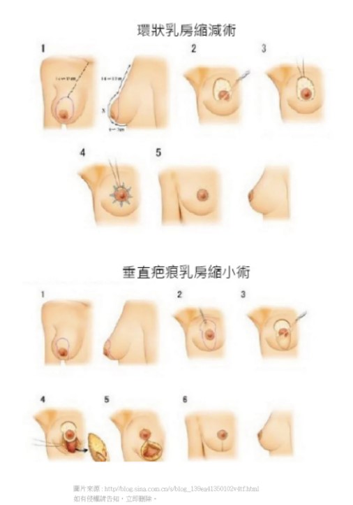 縮乳症術式