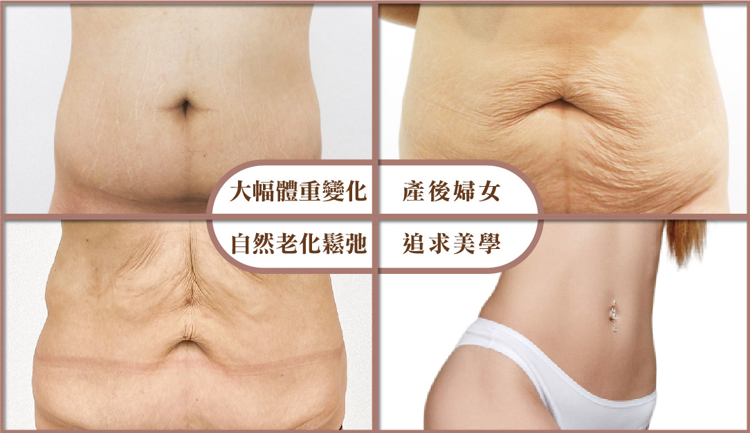 腹部拉皮手術適合哪些人？4大族群全解析！M-1