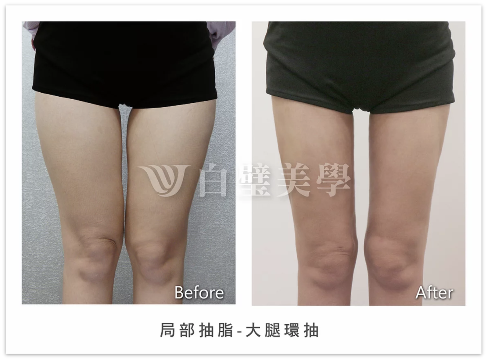 白璧抽脂實例-大腿環抽