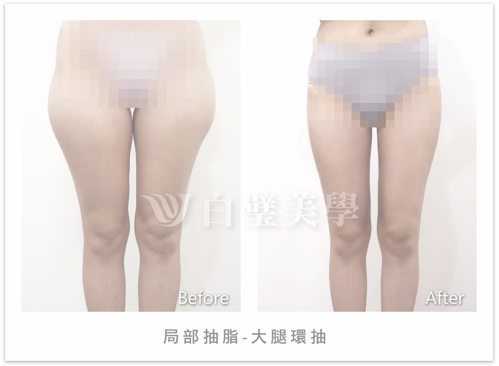 抽脂：馬甲線、男性女乳症、微笑線-4