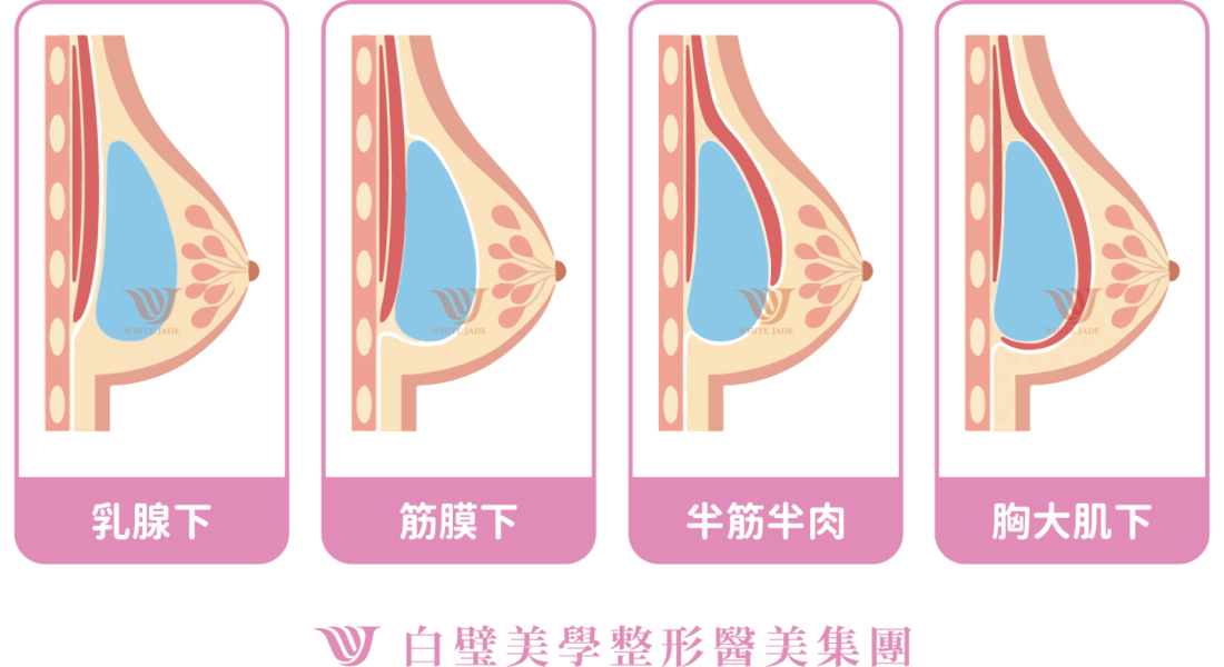 筋膜下植入需要精準的剝離技術