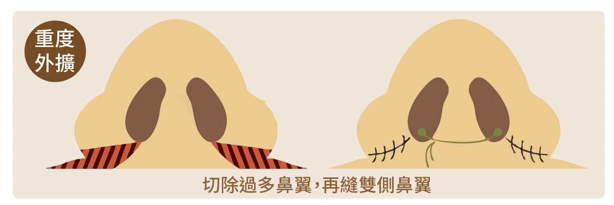 縮鼻翼手術術式-2