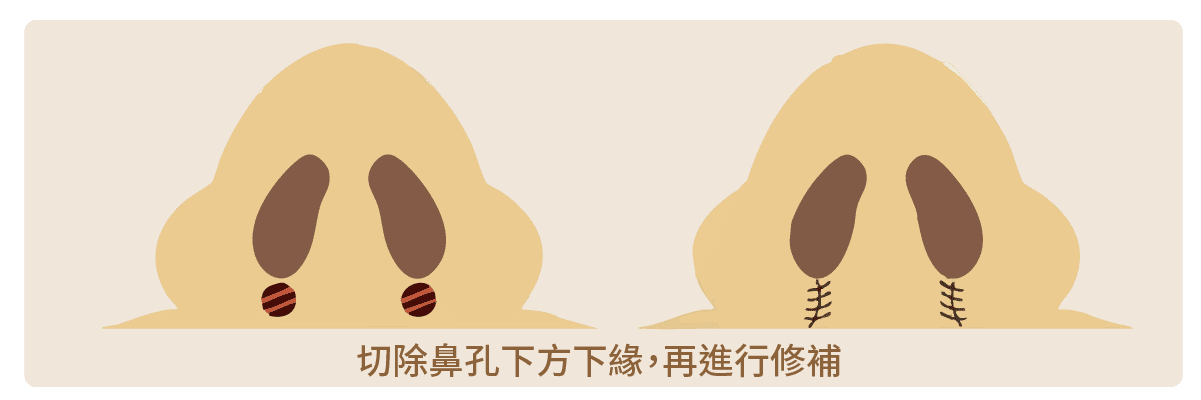 縮鼻翼手術術式-3