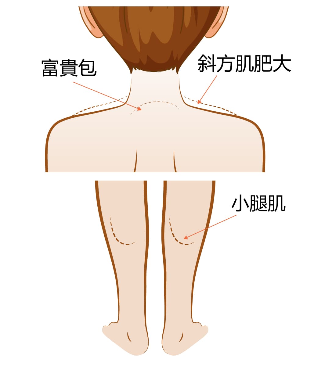 肉毒桿菌素適用部位-2M