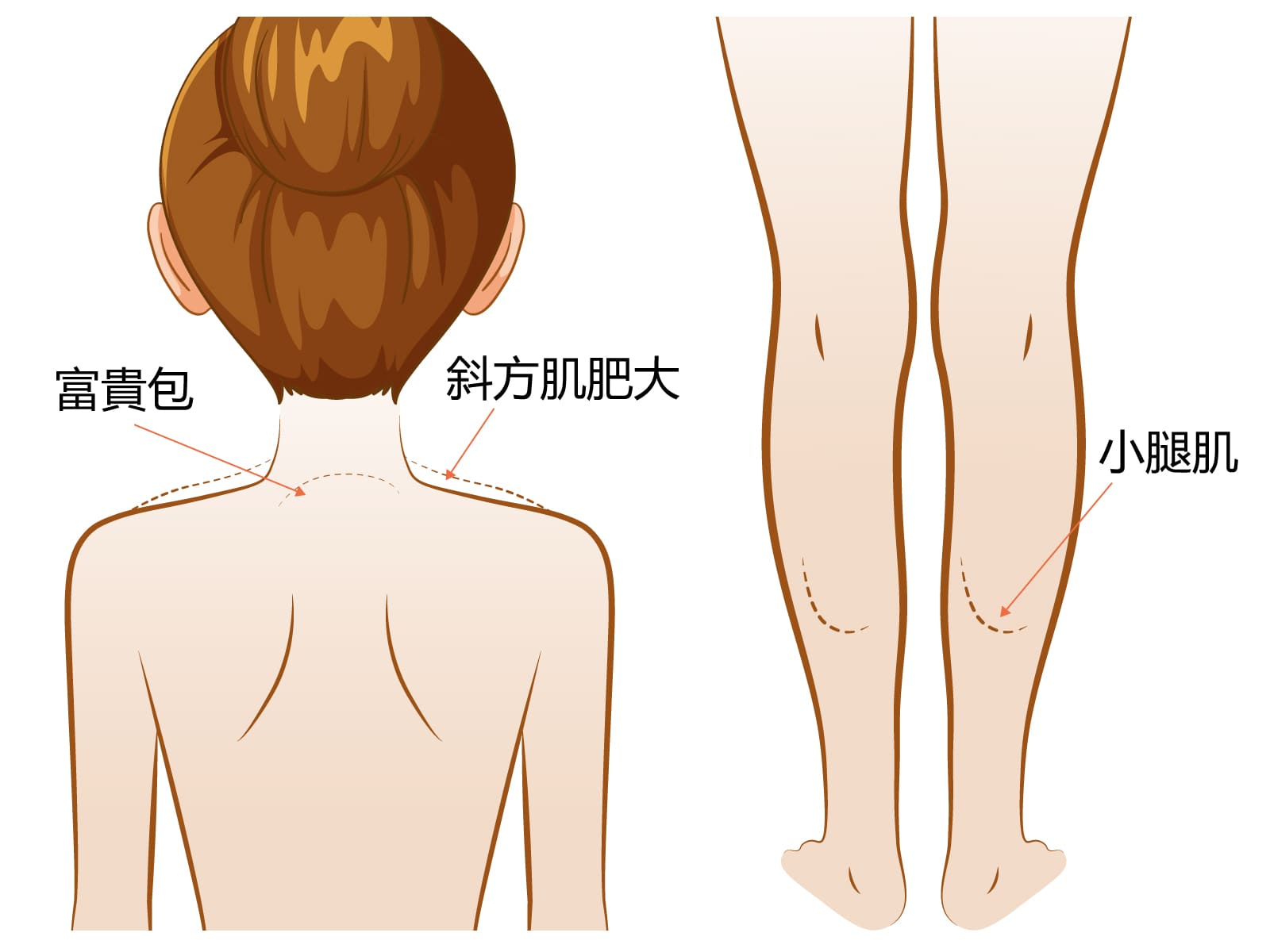 肉毒桿菌素適用部位2