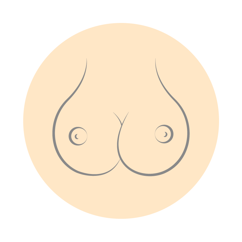 隆乳重修原因：對胸型不滿意