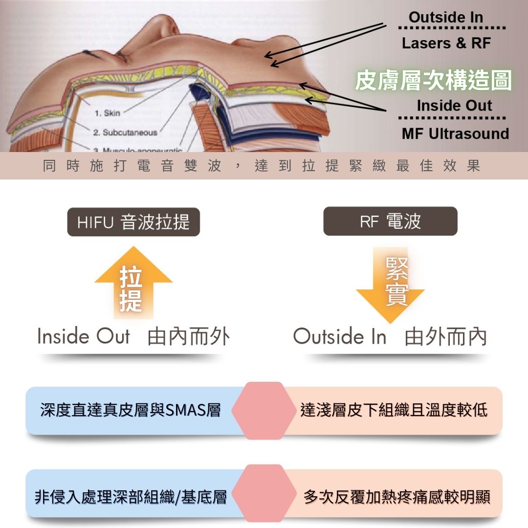 音波拉提治療深度深直達SMAS層-2