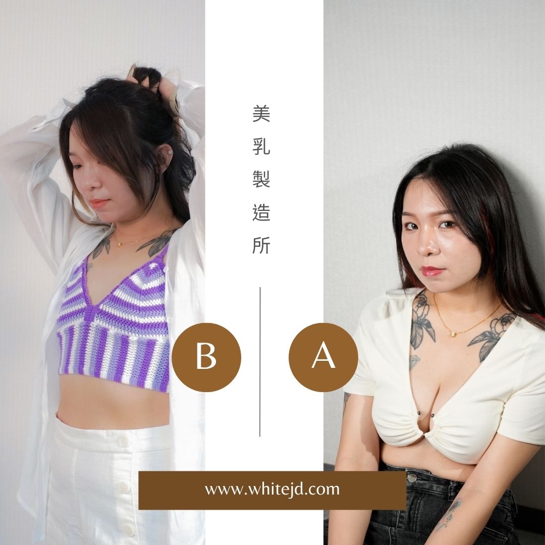 台南白璧刀房護理師隆乳手術前後照-1