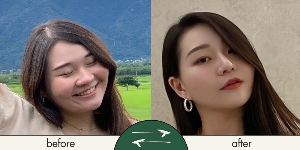 白璧縮鼻翼手術前後對照2