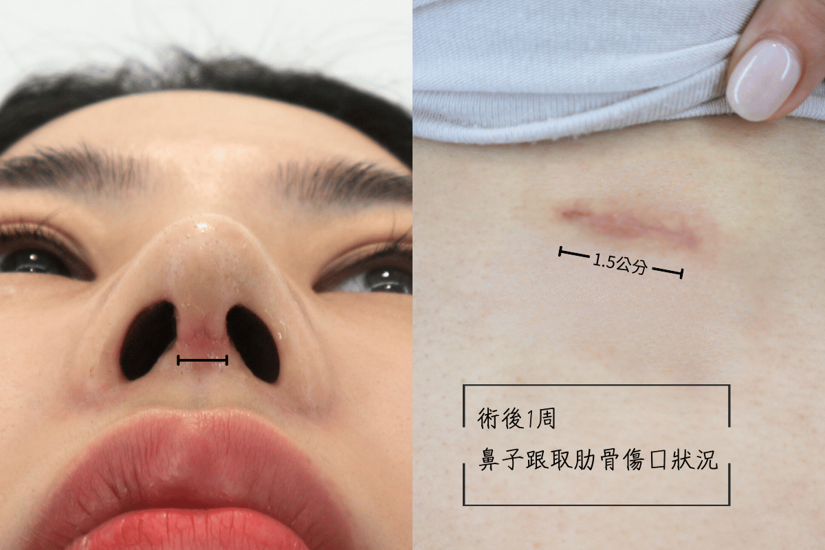 用半自肋隆鼻鼻子疤痕跟取肋骨的疤痕會很難照顧