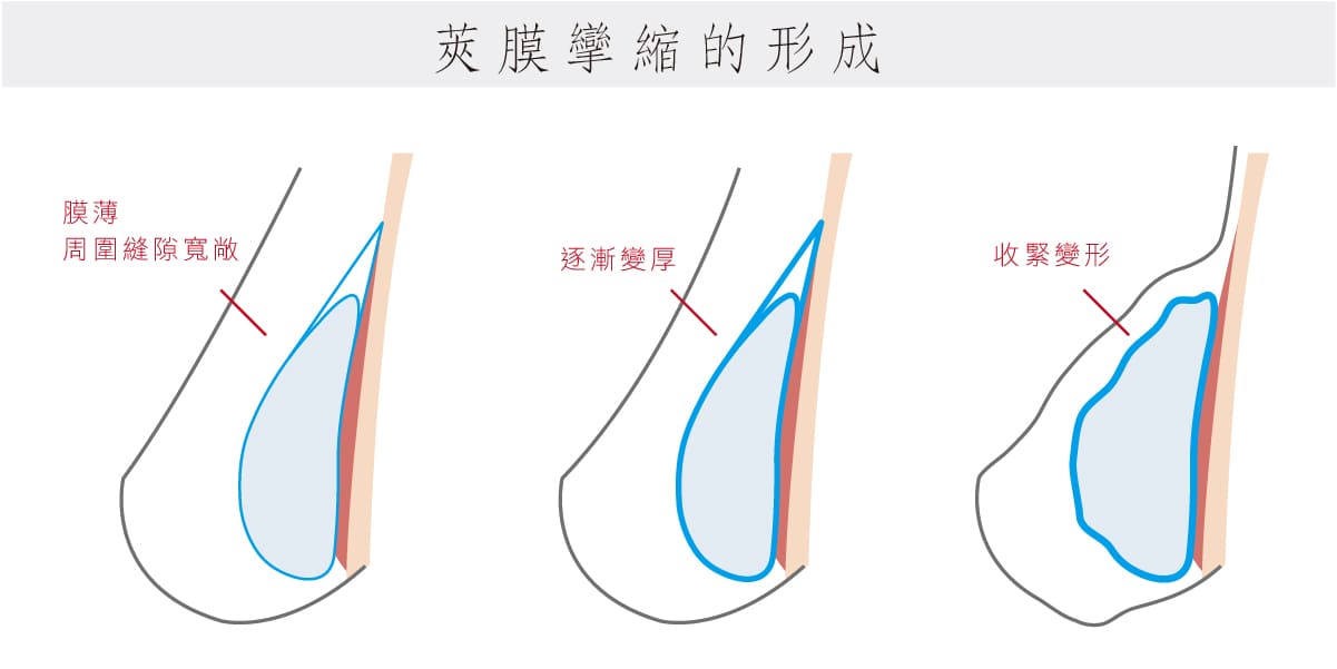 莢膜攣縮原因