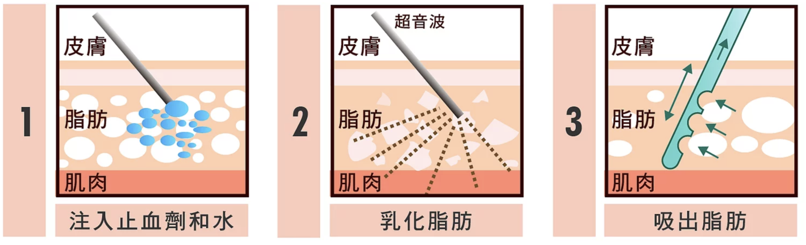 超音波抽脂方式